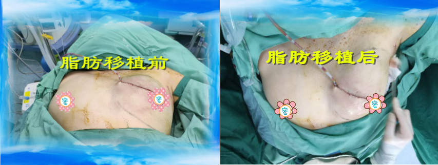 乳腺癌保乳切除前哨淋巴结活检及i期自体脂肪移植乳房整形修复手术