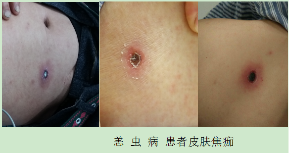 20140303恙虫病-谷强业