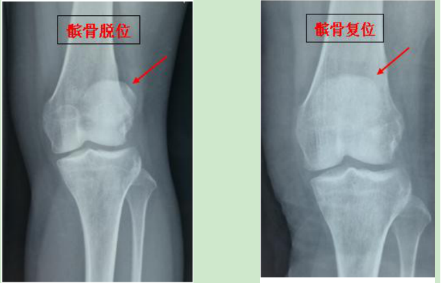骨科病院完成首例关节镜下髌骨脱位微创治疗手术-陕西省人民医院