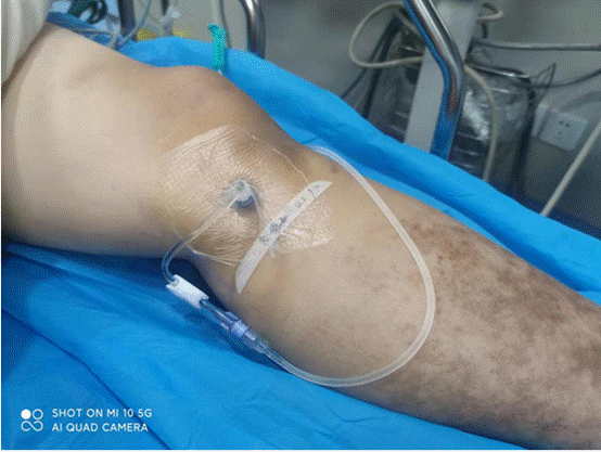 急诊外科成功进行一例骨髓腔穿刺输液