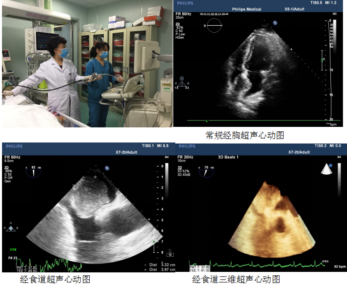 我院首例床旁经食道超声心动图tee在icu成功实施