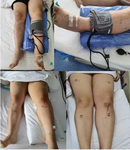 血管外科完成我院首例压力可控式下肢静脉溶栓治疗