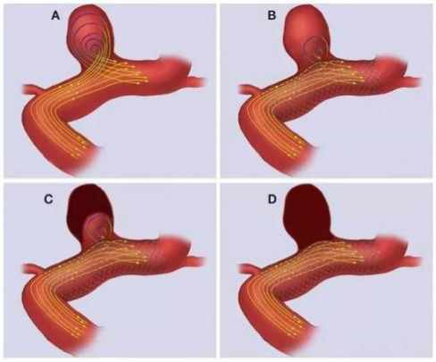 介入放射手术室成功开展首例巨大脑动脉瘤密网支架置入术