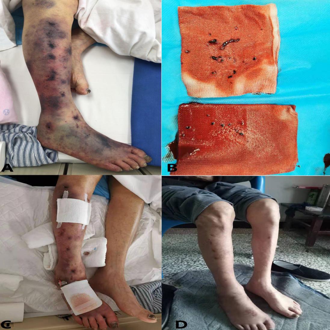 血管外科成功救治一例高龄重度下肢动脉缺血患者