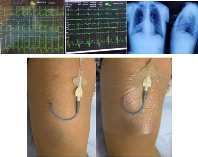 妇科完成医院首例b超引导下腔内心电定位隧道式picc植入术